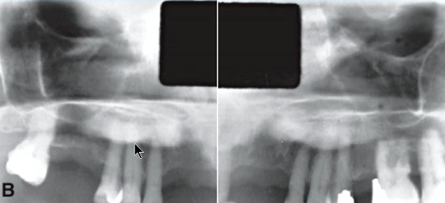 <p>what is the likely diagnosis of the radiopacity </p>
