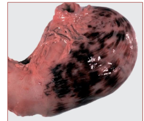 <p>larger contiguous areas of hemorrhage</p>