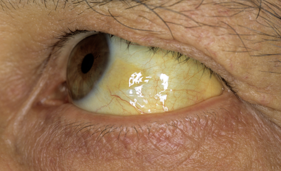 <p>A toxic buildup of unconjugated bile slats from the liver will cause skin and eye scleras to take a yellowish tint. Eyes and anterior wrists are early indicators, common in newborns.</p>