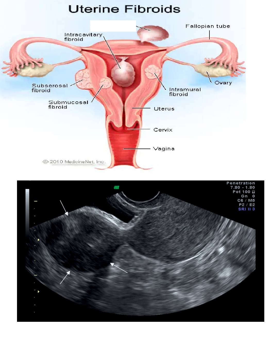 <p>What kind of fibroid is this? </p><p>Has a stalk </p>
