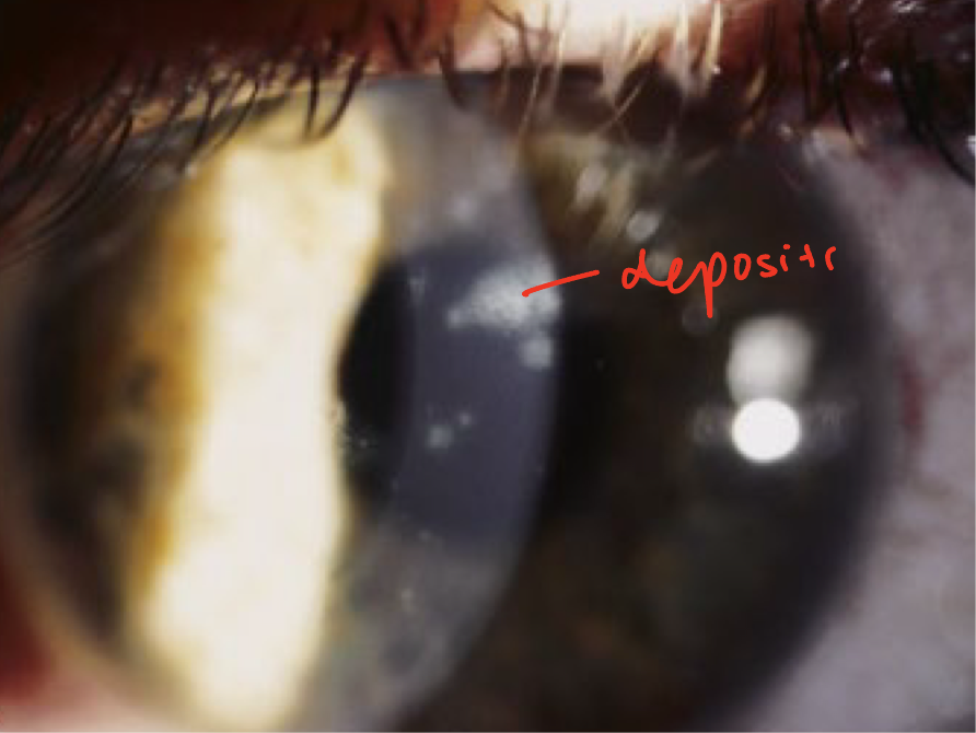 <ul><li><p><span>develops at the site of the epithelial lesions</span></p></li><li><p><span>Occurs 10 days after the onset of the rash</span></p><ul><li><p>after psuedodendrite stage</p></li></ul></li><li><p><span>Characterized by fine granular subepithelial deposits</span></p><ul><li><p><span>Deposits will have a halo of stroma haze surrounding it</span></p></li></ul></li></ul><p></p>