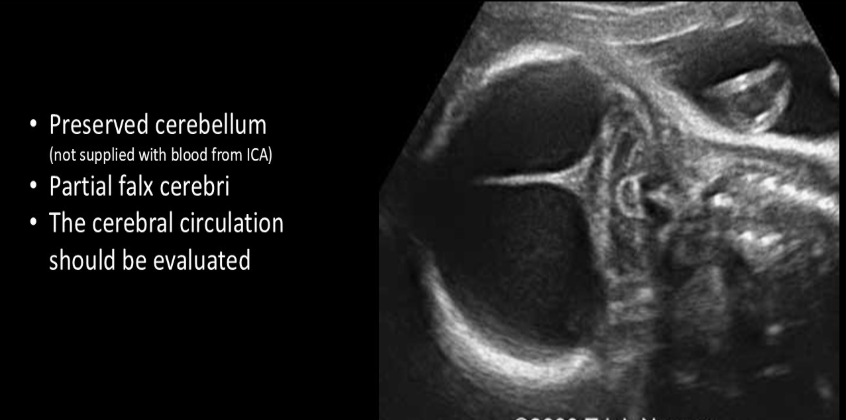<p>the sono look of <strong>hydr<em><u>anencephaly</u></em></strong> is</p><p></p><p>.</p><p>a) the cerebellum is usually absent or malformed w/enlarged cisterna magna</p><p>b) fluid filled sacs of cerebrospinal fluid in cranial cavity, varying amounts of tissue may remain as atrophy + necrosis occurs</p><p>c) an abn brain stem is usually identified w/cisterna magna &lt;2mm</p><p>d) single large c-shaped ventricle is present</p>
