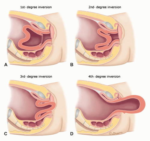 <p><strong>False.</strong></p><p>In an inversion of the uterus, the fundus of the uterus (the top part) is <strong>no longer invertible</strong>. It has essentially turned inside out, becoming invaginated into the vagina.</p>