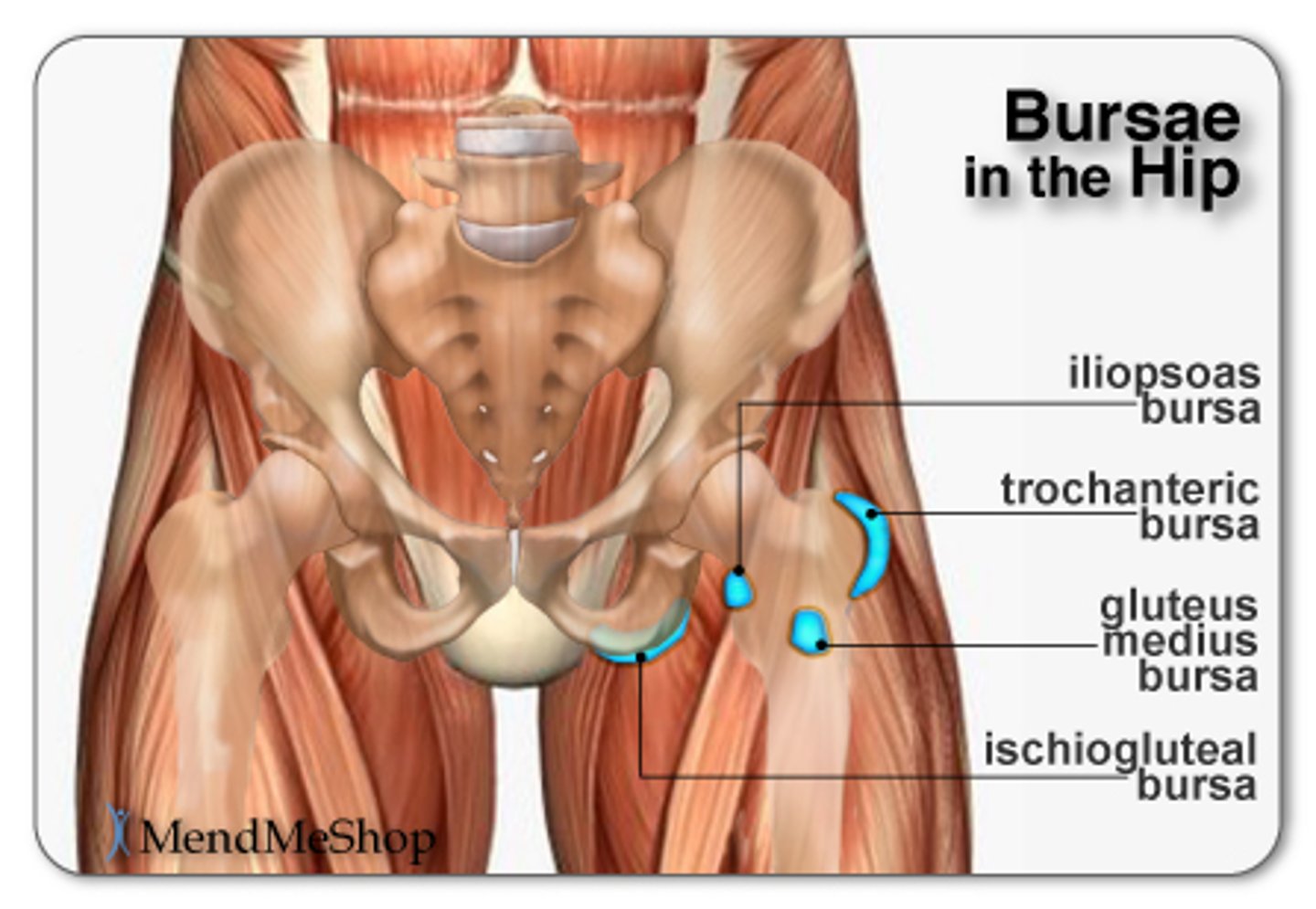 <p>- inflammation of the iliopsoas bursa causing anterior hip/groin pain</p><p>- caused by repetitive hip flexion (sports, poor posture, leg length discrepancy,)</p>
