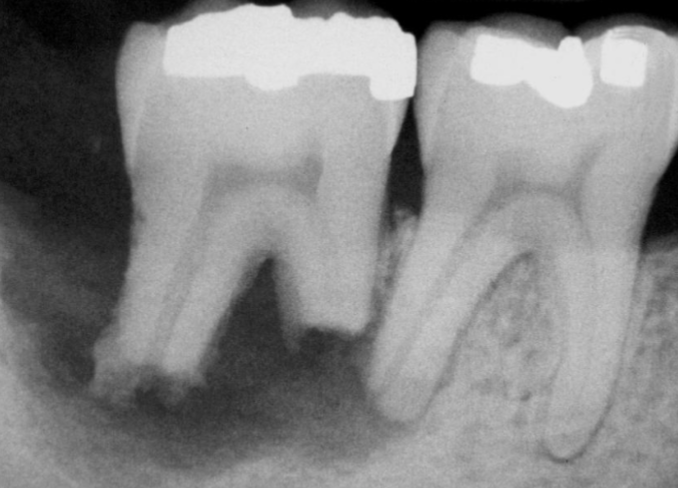 <p>shortened/ irregularly shaped root apex </p>