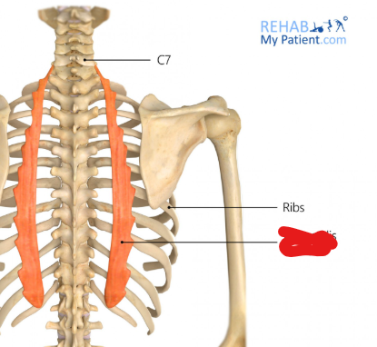 <p>Origin: Upper borders of the angles of ribs 7-12, medial to the tendons of insertion of the lliocostalis lumborum</p><p>Insertion: Into the upper borders of the angles of ribs 1-6 and into the back of the transverse process of vertebra C07</p><p>Innervation: Dorsal primary rami of nerve C08 and the thoracic and upper lumbar nerves</p><p>Action: Extension and lateral flexion of the spine</p>