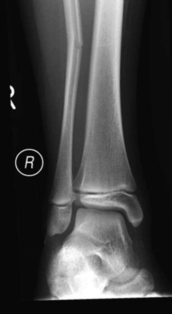 <p>What type of fracture is this?</p>