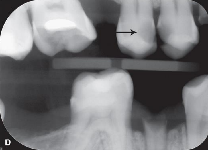 <p>classify this lesion according to the ADA and ICDAS/ICCMS systems </p>