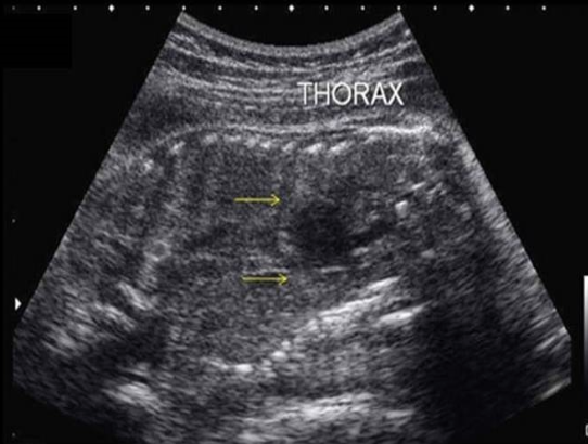 <p>a) congenital cystic adenomatoid malformation + pulmonary sequestration</p><p>b) potter syndrome + diaphragmatic hernia</p><p>c) vein of galen malformation + cardiomegaly</p><p>d) thanatophoric skeletal dysplasia + osteogenesis imperfecta </p>