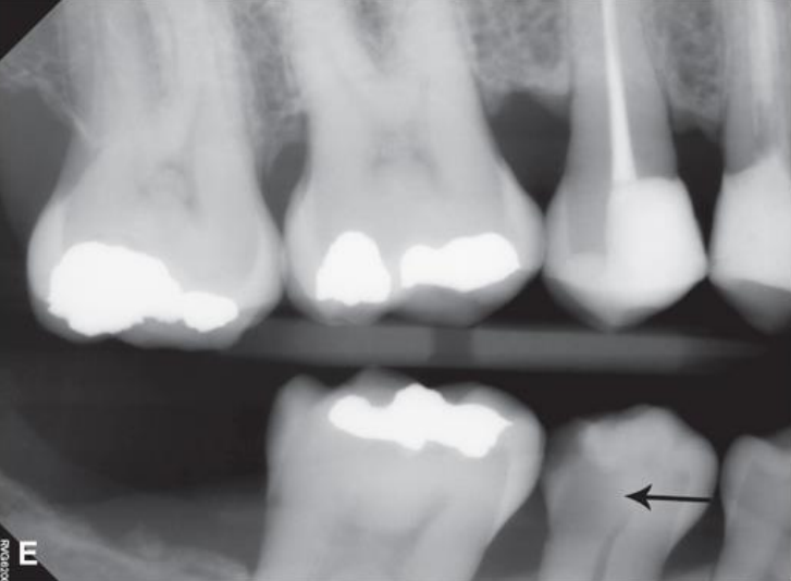 <p>classify this lesion according to the ADA and ICDAS/ICCMS systems </p>