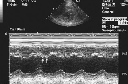 <p>A 68 year old woman presents with a two month history of increasing dyspnea, chest pain and decreased exercise tolerance.&nbsp; Her past medical history is remarkable for rheumatoid arthritis, HTN and a coronary bypass 10 years ago.&nbsp; BP is 138/86, HR, 88 and respirations 14/min.&nbsp; On inspiration, a friction rub is noted.&nbsp; Echo reveals normal LV size and function, no significant pericardial effusion.&nbsp; Doppler shows a restrictive physiology, but respiratory variation is noted with the use of a respirometer.&nbsp; What is the most likely diagnosis in this patient?</p><p></p><p>Pericardial tamponade</p><p></p><p>Constrictive pericarditis</p><p>&nbsp;</p><p>Restrictive cardiomyopathy</p><p>&nbsp;</p><p>Dilated cardiomyopathy</p><p>&nbsp;</p><p>Hypertensive heart disease</p>