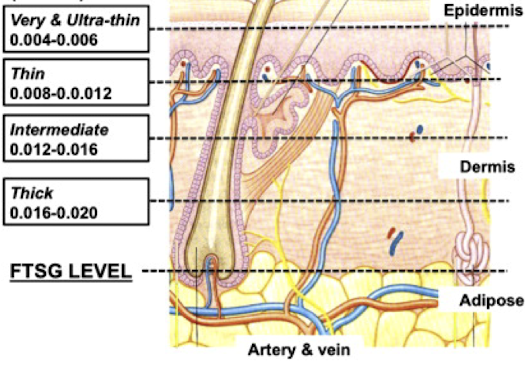 <p><strong>graft that contains the </strong><span style="color: blue"><strong>complete epidermis and dermis, sometimes muscle and fascia</strong></span></p><p>-donor site should be chosen from area with <strong>optimal tissue match</strong> and least significant scarring: <span style="color: red"><strong><em>donor site is often slowest to heal and most common source of postoperative discomfort</em></strong></span><br><strong>-Does NOT maintain original blood supply</strong>, rely on recipient region</p>