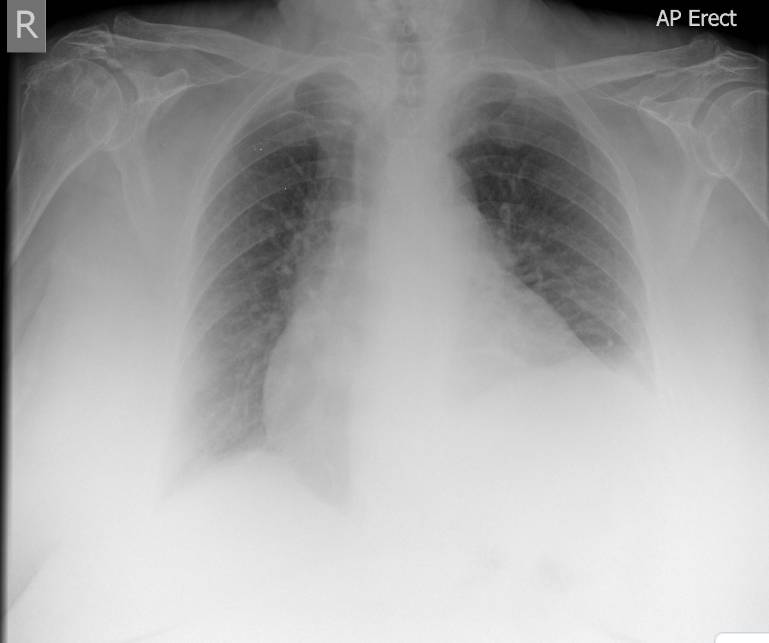 <p>Given the image, a technologist could ____ and ____ on a repeat radiograph. This would result in lower patient dose and better penetration of the hilar region.</p>
