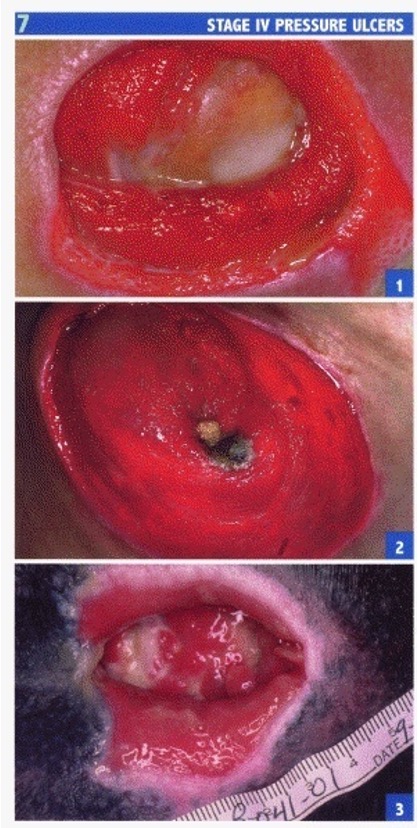 <ul><li><p>full thickness skin loss</p></li><li><p>destruction of tissue, muscle, and/or bone</p></li><li><p>sinus tracts (tunneling wounds) are common</p></li></ul><p></p>