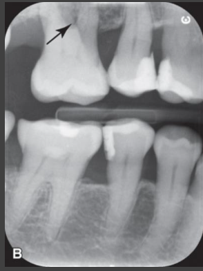<p>What radiographic modality would you use for periodontal disease?</p>