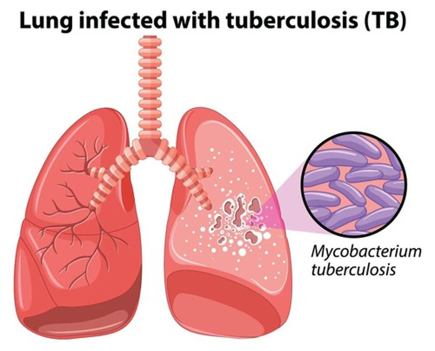 <p>-infectious disease caused by bacillus mycobacterium tuberculosis</p><p>-AIRBORNE! only need one single micro droplet to contract it</p><p>-occurs mainly in lungs but can spread to other organs</p><p>-primarily affects lungs (can spread to kidneys, spine, brain)</p>