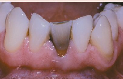 <ul><li><p>Pulp death after RCT</p></li><li><p>Age</p></li><li><p>Gets darker with time</p></li><li><p>Tooth is brittle</p></li><li><p>cannot bleach enamel</p></li><li><p>color doesn’t change with new RCT</p></li><li><p>Post and crown</p></li></ul><p></p>