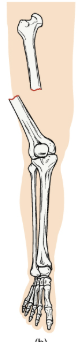 <p>type of fracture that breaks the skin</p>