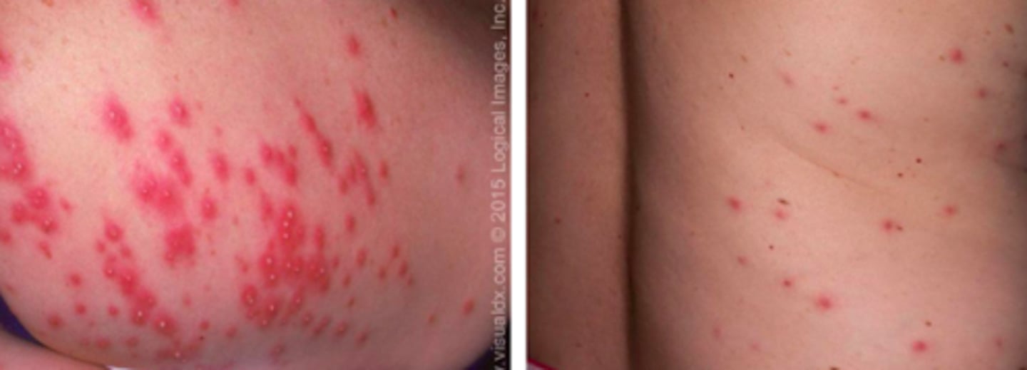 <p>Bacterial ID:</p><p>- Caused by pseudomonas aeruginosa (gram -)</p><p>- Contact with water contaminated with pseudomonas - can be result of inadequate sanitation in whirlpools, hot tubs, and swilling pools</p><p>- Bathing with contaminated sponges/nylon towels, or use of contaminated rubber gloves</p><p>Pruritic, inflamed, follicular macules, papules, or pustules</p><p>~ 8-48 hours after exposure</p><p>- Primarily on trunk and buttocks in distribution of wet bathing suit or other areas exposed to contaminated water</p>