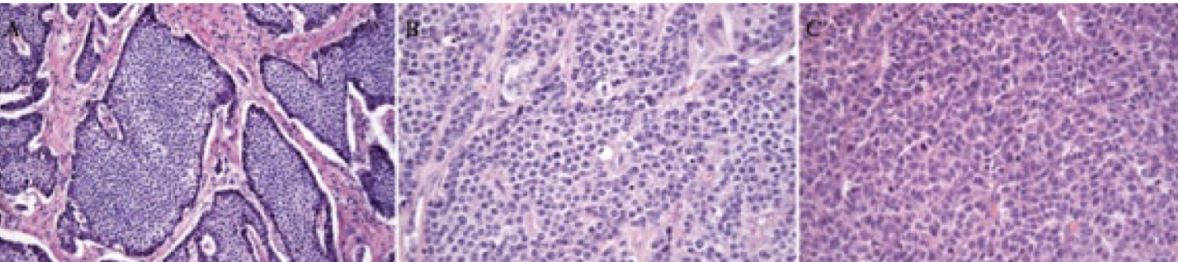 <p>higher grade gastric NET with no hypergastrinemia, normal acid secretion, higher metastatic rate and poorer prognosis; graded from well-differentiated NET to neuroendocrine carcinoma</p>