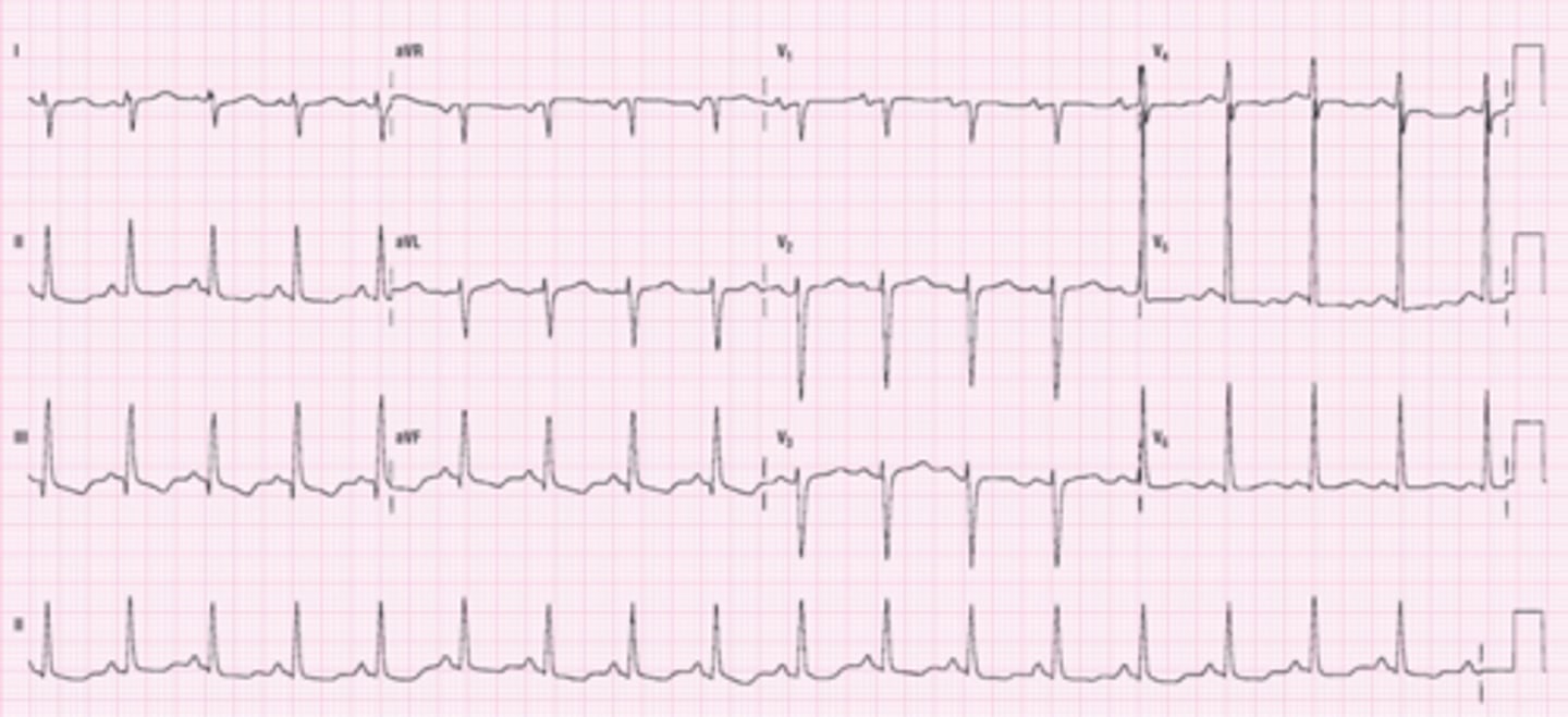 <p>Which Arrythmia is this?</p>
