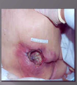 <p>Pressure Injury Stage 3</p>