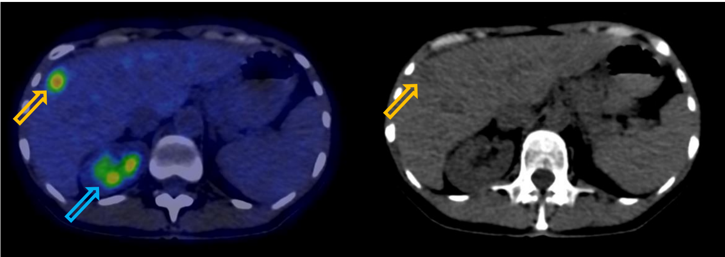 <p>Patient history: colorectal tumor, elevated CEA-level, staging</p><p>Modality: FDG PET-CT (right panel: noncontrast CT); 18(F)-fluorodeoxyglucose</p><p>Region: upper abdomen, axial view</p><p>Sign: increased focal uptake in the liver; physiological high uptake in the right kidney</p><p>Diagnosis: malignant tumor (colorectal adenocarcinoma metastasis) in the liver</p>