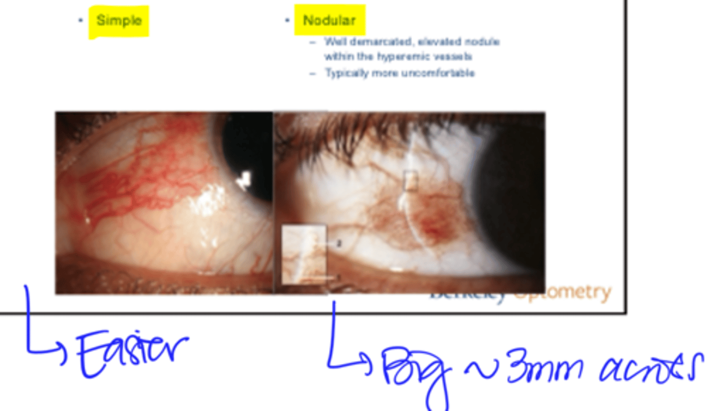 <p>1) Simple </p><p>- Easier to treat</p><p>2) Nodular </p><p>- Well demarcated, elevated module within the hyperemic vessels</p><p>- Typically more uncomfortable</p><p>- Big, ~3mm across</p>