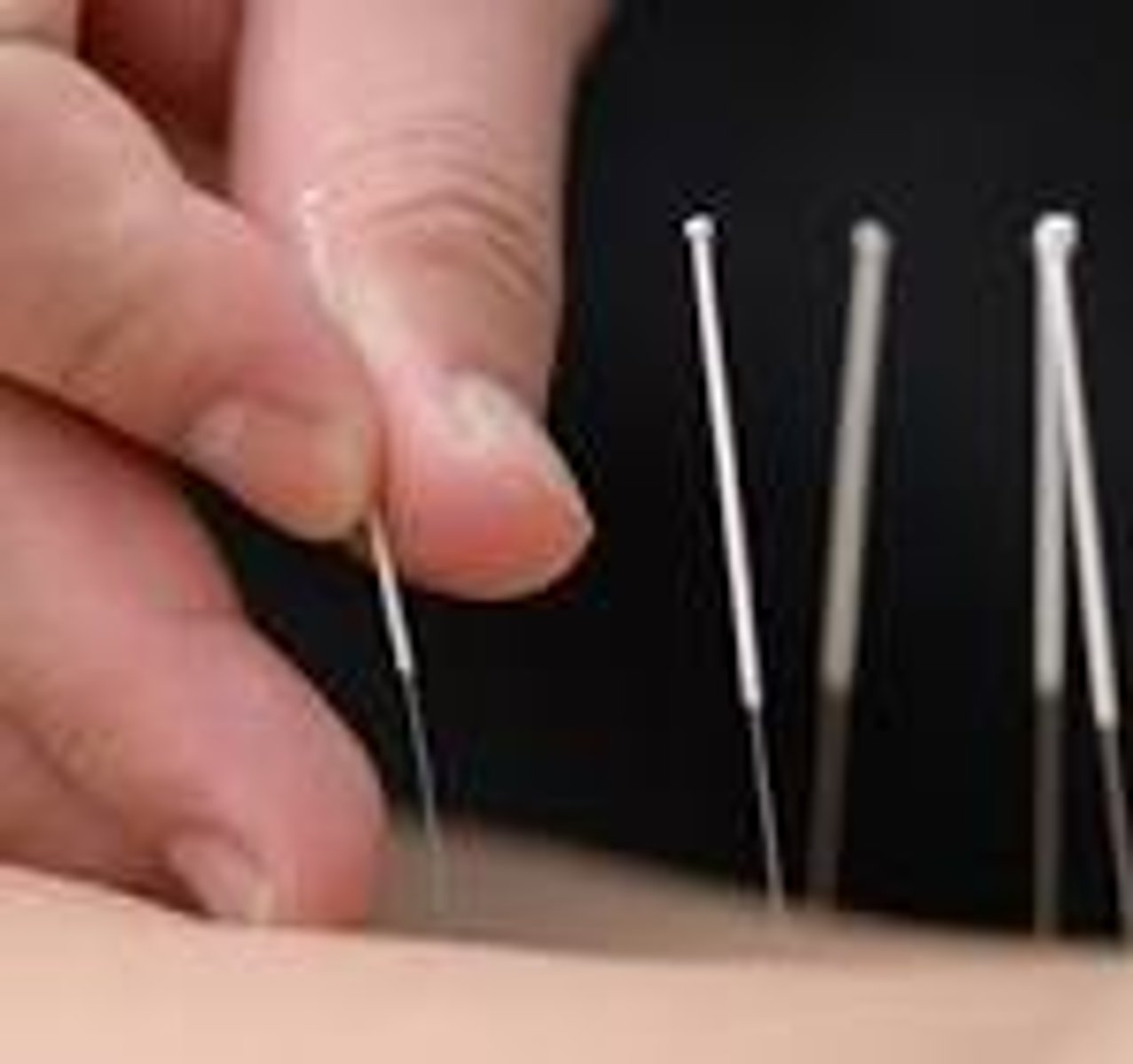 <p>small electric current applied through needles to block pain (such as surgical pain.)</p>