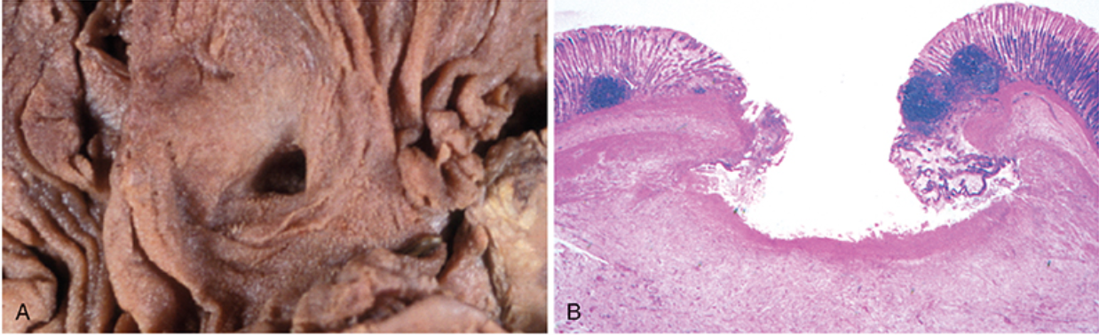 <p>es un defecto o excavación local en la superficie de un órgano o tejido, inducido por esfacelación (desprendimiento) de tejido necrótico inflamado</p>
