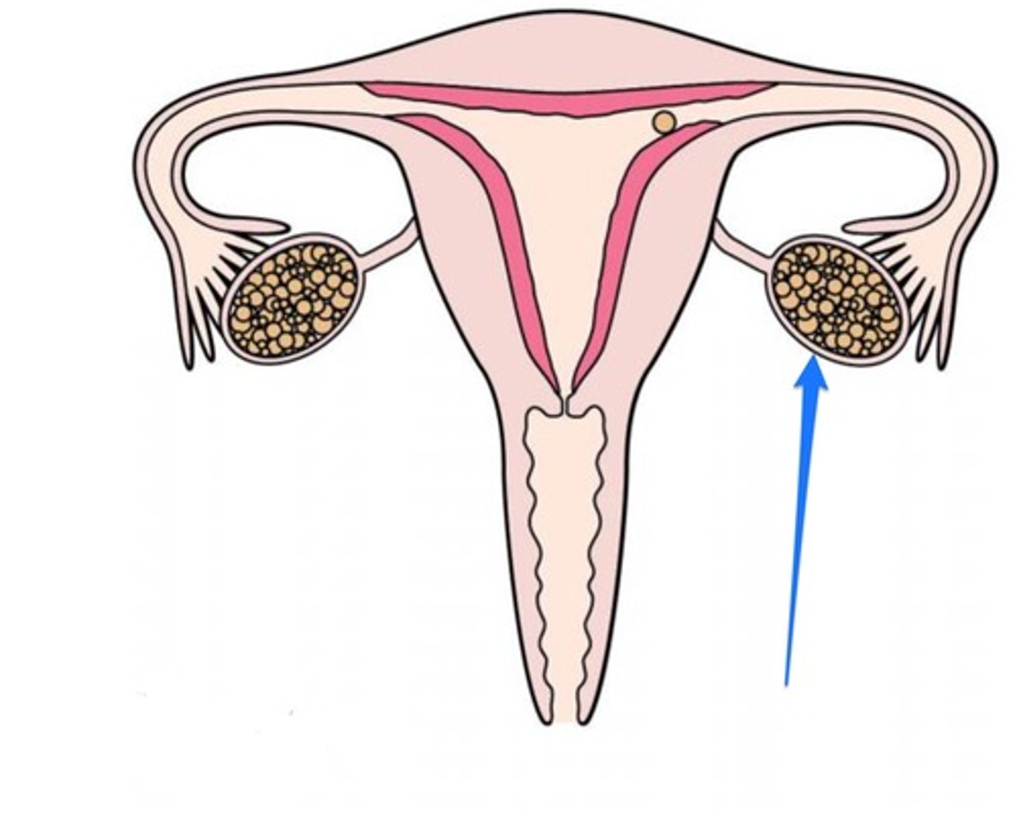 <p>inflammation of the ovary</p>