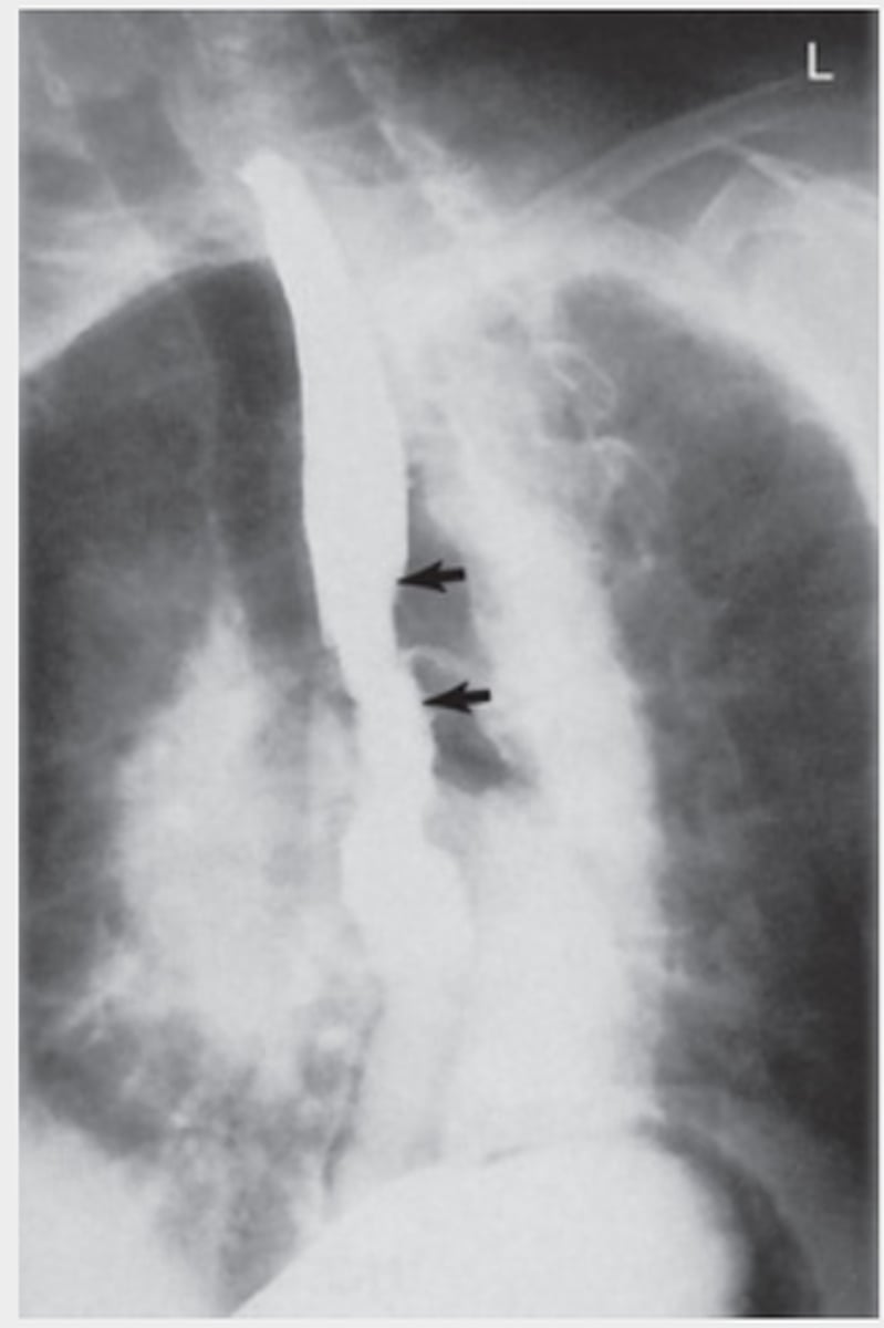 <p>Prone, 35-40 degree LAO, places esophagus between spine and hilar region of lungs. Looks for specific constricted areas and pathology</p>