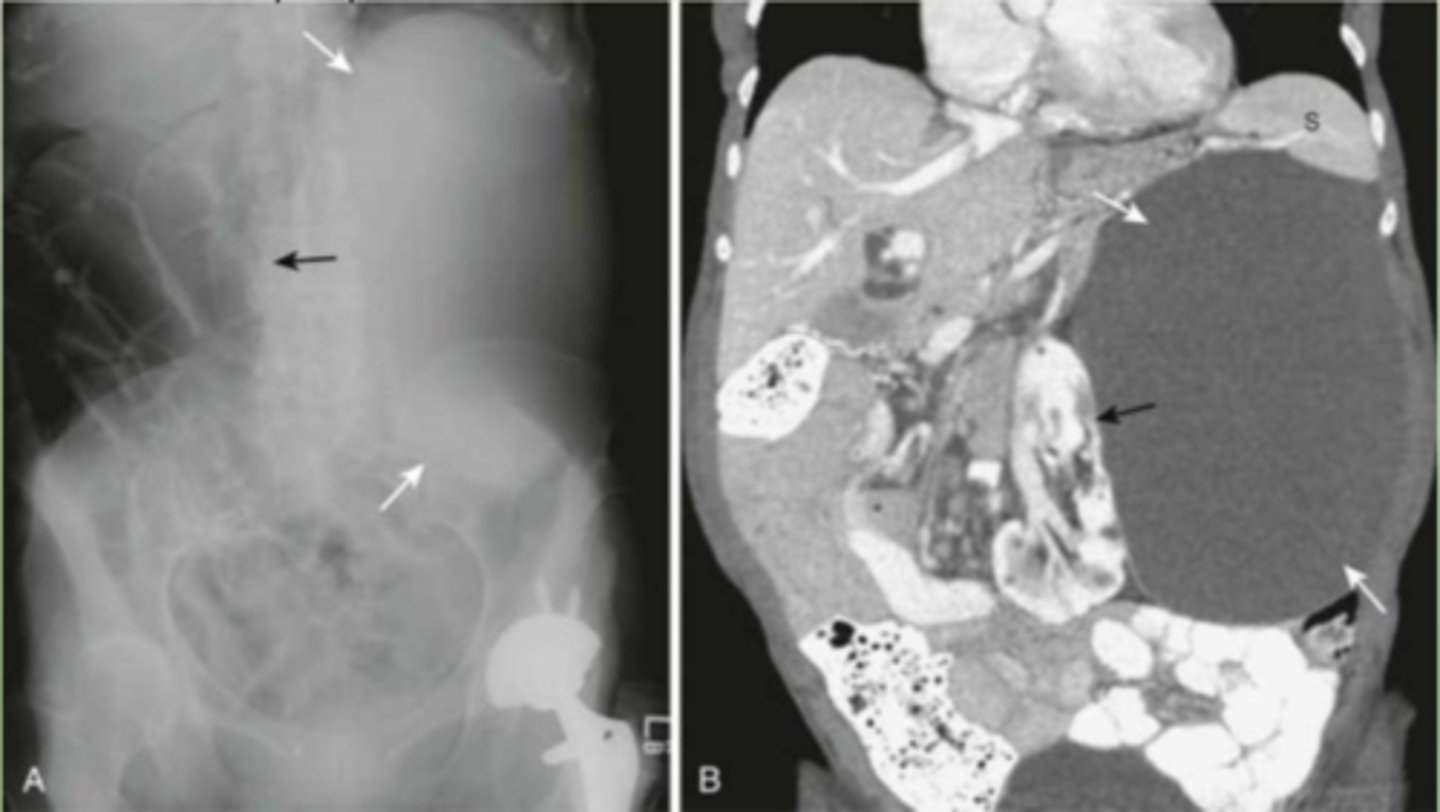 <p>extremely enlarged organ or large masses, large cyst compressing and displacing other organs</p>