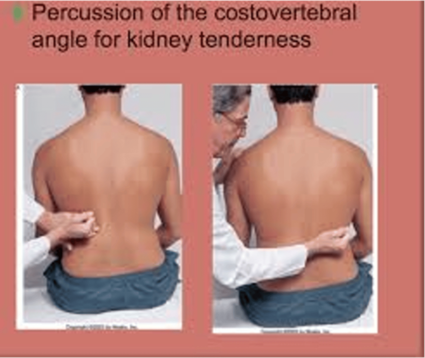 <p>Positive finding indicates inflammation of the kidney.</p><p>A person normally feels thud but no pain</p>
