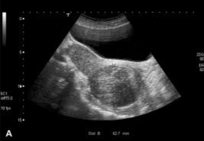 <ul><li><p>8% of fibroids (myomas, leiomyomas, fibromyoma)</p></li><li><p>Most are small and asymptomatic</p></li><li><p>Observe for growth</p></li><li><p>Common during <span style="color: #a700ff">reproductive years</span></p></li></ul><p></p>
