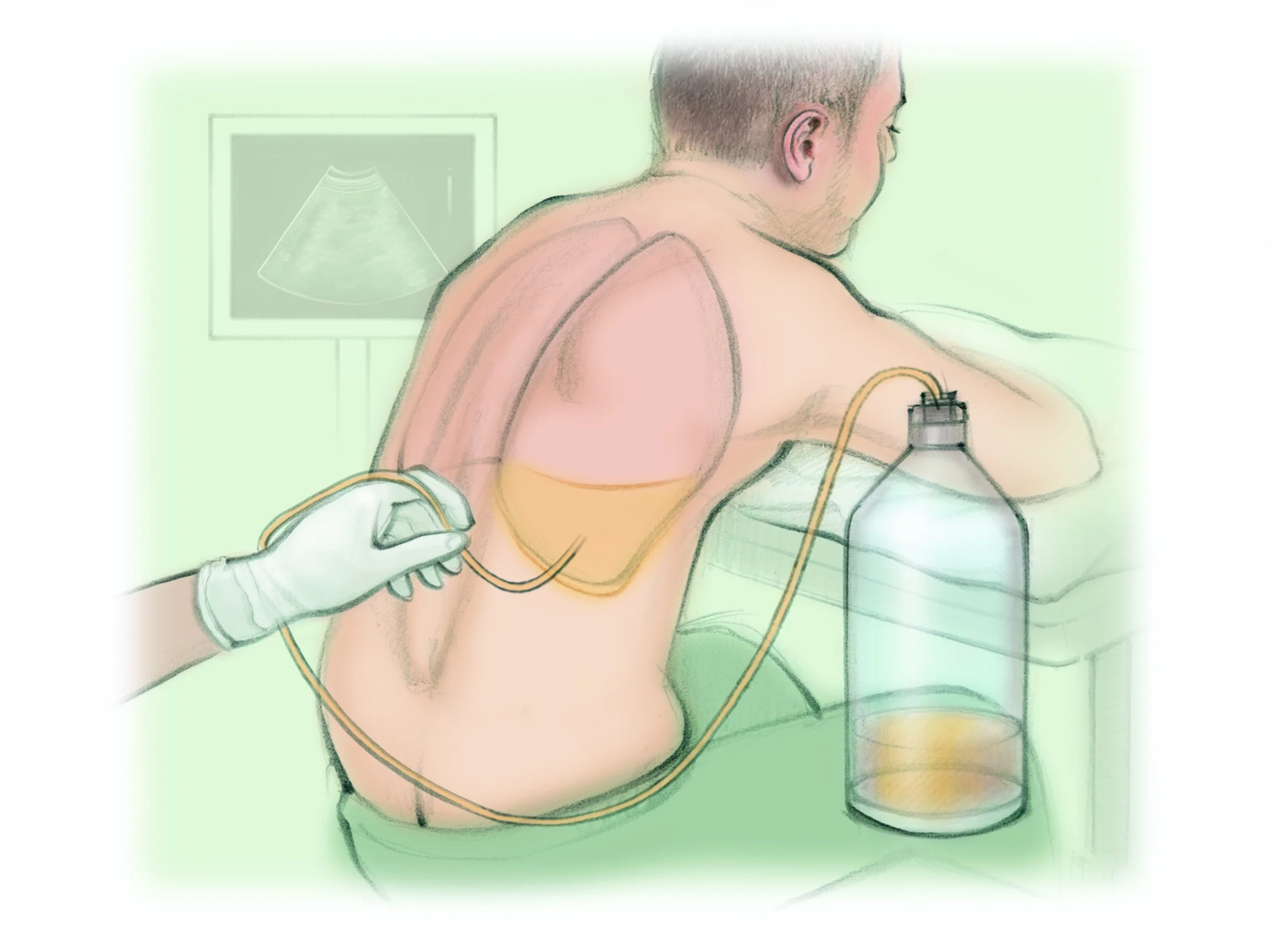 <ul><li><p>Needle inserted into pleural space to remove fluid/air.</p></li><li><p>Position: Upright, leaning forward.</p></li><li><p>Risks: Pneumothorax, bleeding, infection.</p></li><li><p>Post: Monitor breath sounds, O₂ sat, chest X-ray to rule out pneumothorax.</p></li></ul><p></p>