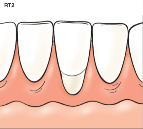 <p>Gingival recession with loss of interproximal attachment</p><p>Amount of interproximal attachment loss less than or equal to buccal attachment loss</p>