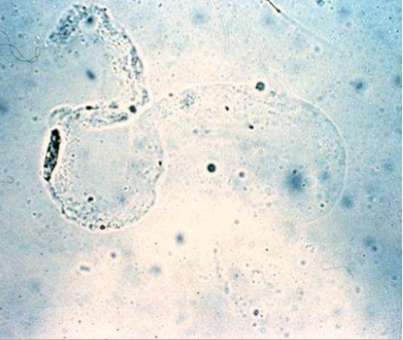 <p>What type of cast is pictured?</p>