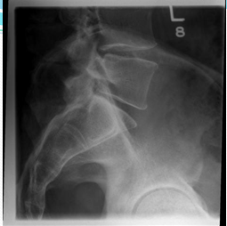 <p><strong>Correct area </strong>of interest to include</p><p style="text-align: left;">&nbsp;&nbsp;&nbsp;&nbsp; L4 superiorly.</p><p style="text-align: left;">&nbsp;&nbsp;&nbsp;&nbsp; Proximal 2/3 of sacrum inferiorly.</p><p style="text-align: left;">&nbsp;&nbsp;&nbsp;&nbsp; Soft tissues anteriorly and posteriorly</p><p style="text-align: left;">&nbsp;&nbsp;&nbsp;&nbsp; following the curvature of the sacrum</p><p style="text-align: left;">&nbsp;<strong>Correct positioning </strong>to include</p><p><span style="font-family: &quot;Wingdings 2&quot;;"></span>Vertebral bodies and sacrum to co-incident with midline of image receptor.</p><p><span style="font-family: &quot;Wingdings 2&quot;;"></span>Superimposition of anterior posterior superior and inferior borders of vertebral bodies and sacrum</p><p><span style="font-family: &quot;Wingdings 2&quot;;"></span>Evidence of intervertebral joint space L4/L5 and L5/S1</p><p><span style="font-family: &quot;Wingdings 2&quot;;"></span>Intervertebral foramina superimposed L4/L5 and L5/S1 </p>