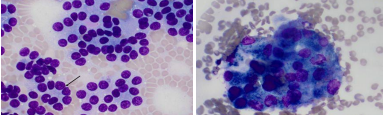 <p>thyroid carcinomas</p>