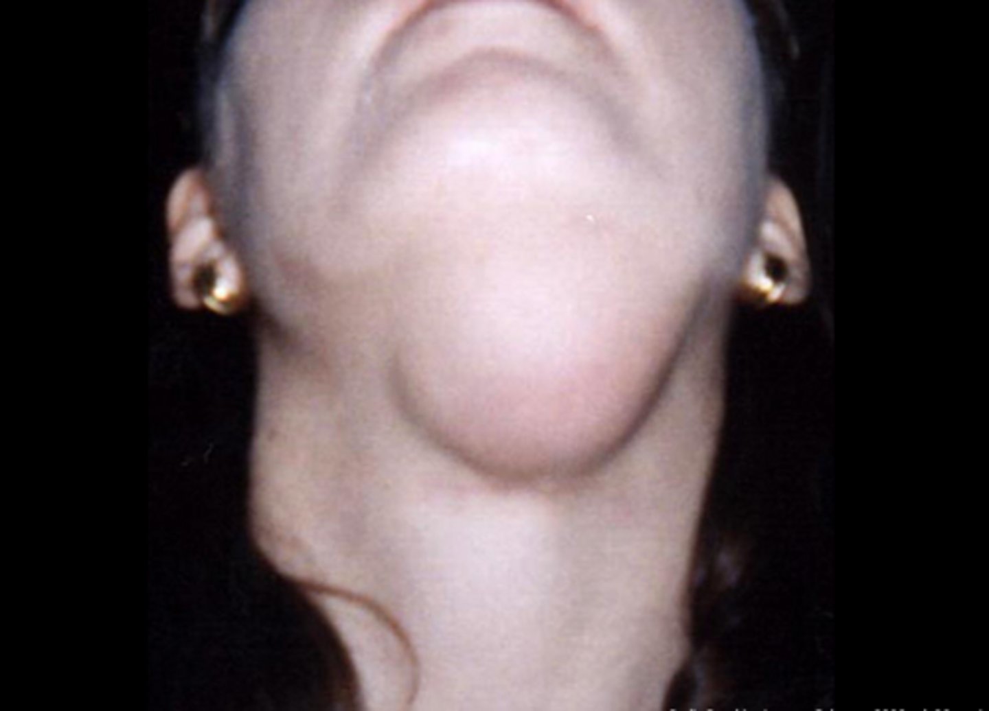 <p>plunging/cervical ranula</p>
