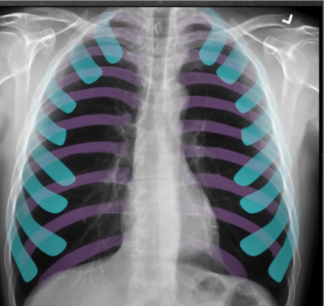 <p>-inspiration: we need good inspiratory effort</p><p>-should see 9-10 posterior ribs or 6-7 anterior ribs (7th piercing the diaphragm)</p>