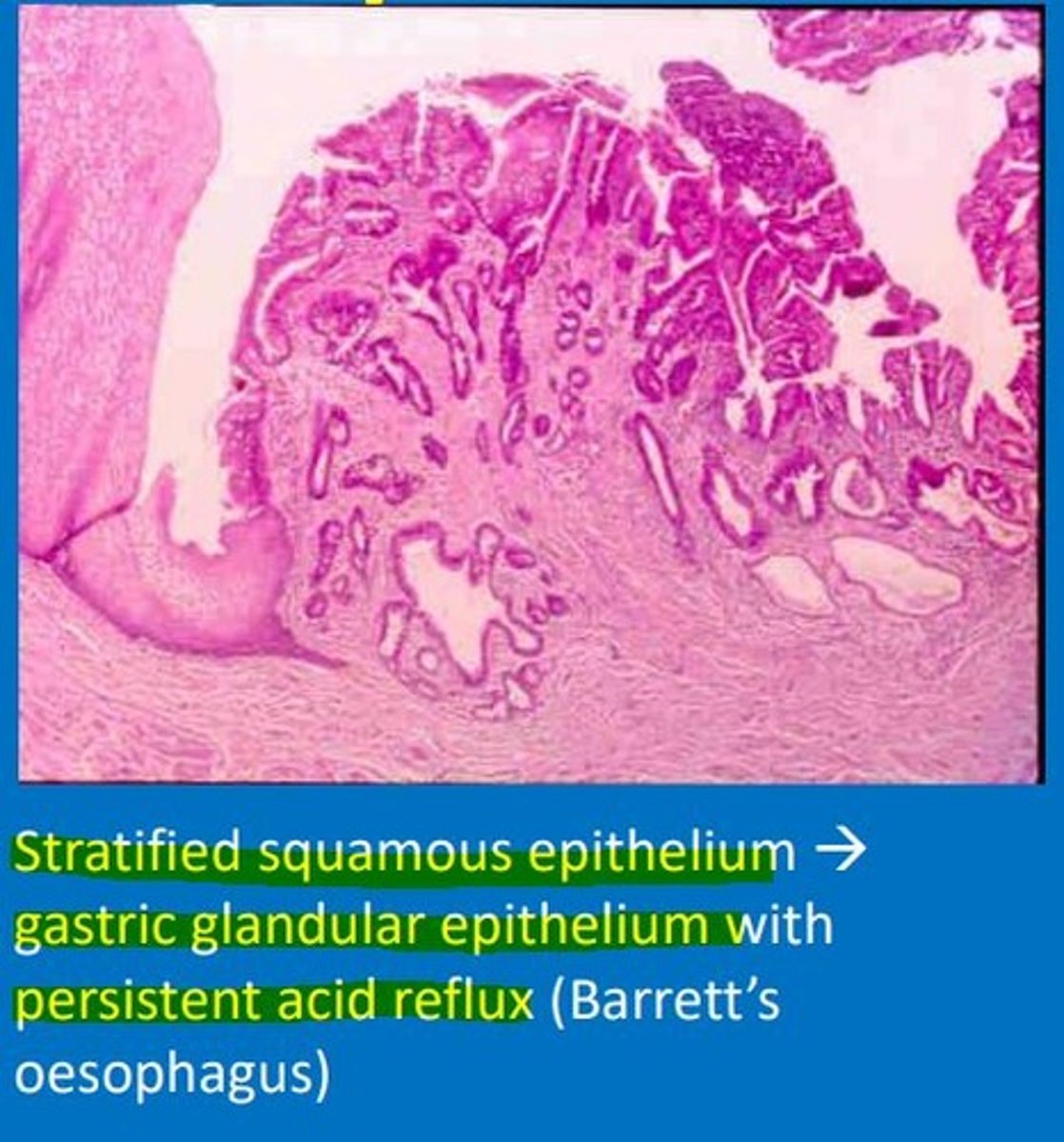 <p>Severe types of epithelial metaplasia predispose to malignant epithelial cancers e.g., Barret's oesophagus and intestinal metaplasia of the stomach (which occurs in chronic H. pylori infection). </p>