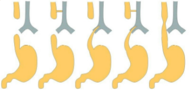 <p>esophagus terminated before reaching the stomach so it ends in pouch or fistula with trachea, food can enter lungs and air enters stomach, treated with surgery</p><p>signs: <strong>Coughing </strong>and <strong>Choking </strong>with feedings and <strong>Cyanosis</strong>, frothy saliva, vomiting, abdominal distention, respiratory distress during and after feeding</p>