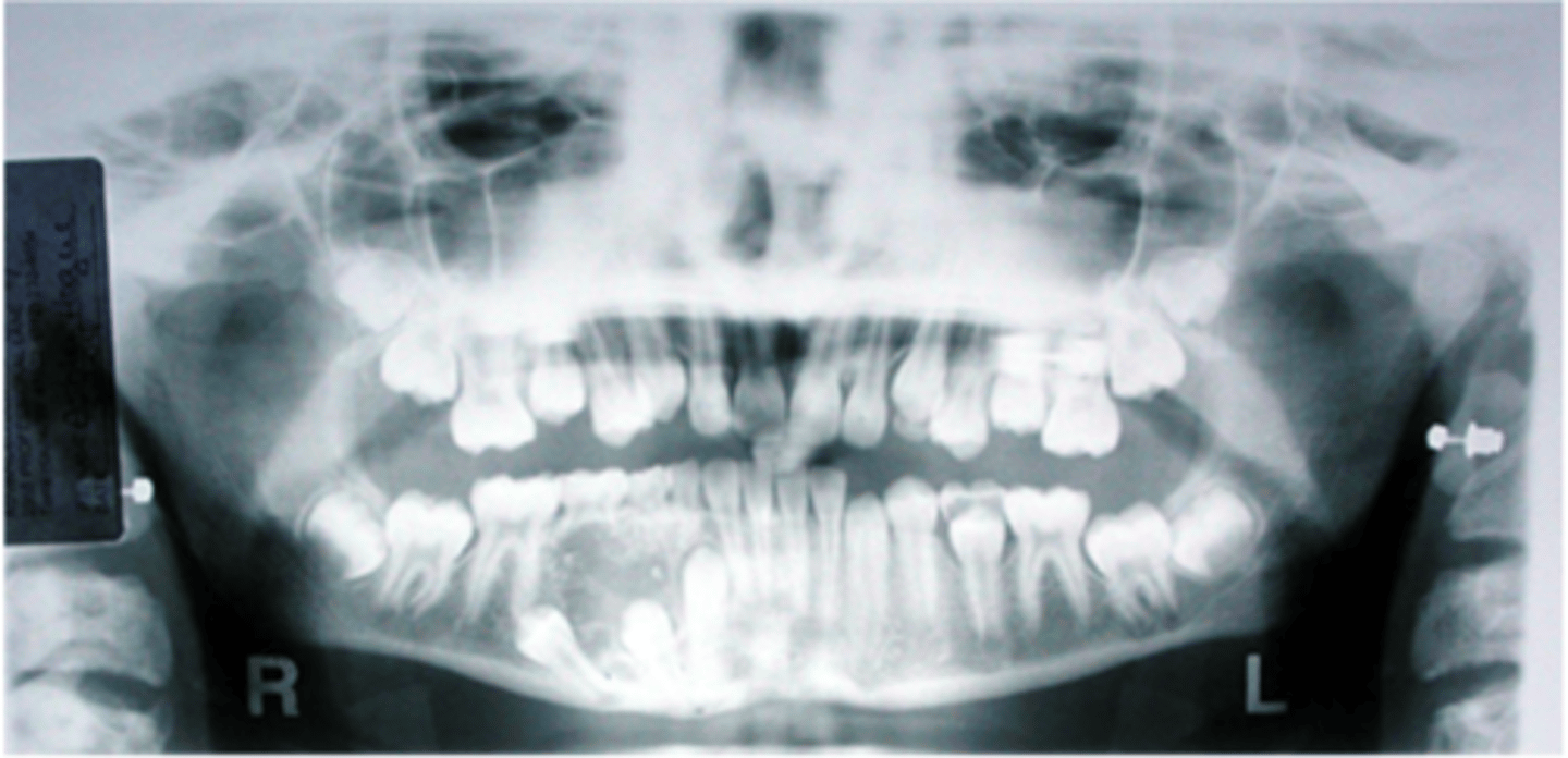 <p>This 11-year-old female presented with an asymptomatic swelling of the mandible. A panoramic radiograph was taken.</p><p>What would be appropriate diagnostic procedures?</p><p>A. Enucleation</p><p>B. Excision</p><p>C. Aspiration</p><p>D. Curettage</p><p>E. Resection</p>