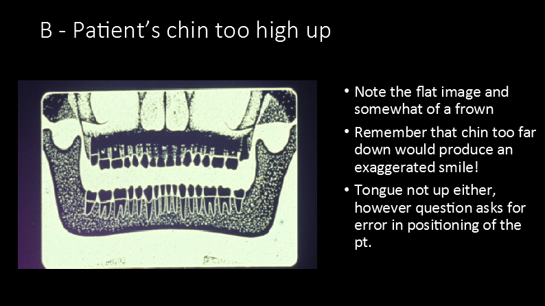 <p>B. Chin  a bit too high up</p>