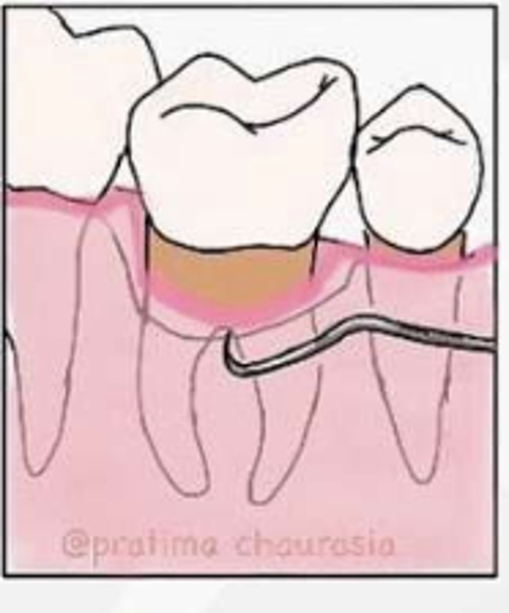 <p>Pocket into furcation &amp; interradicular bone loss, but not completely through to opposite</p>