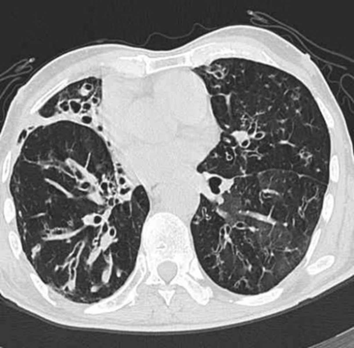<p>Labs: Culture (H. Flu common infection)</p><p>-CXR (bronchovascular markings/atelectasis)</p><p>-CT</p><p>-PFTs (Obstructive pattern)</p><p>Tx: </p><p>-Abx/Tx underlying dz</p><p>-Physiotherapy</p><p>-Surgery to remove affected lobe/area</p><p>-Vaccines</p>
