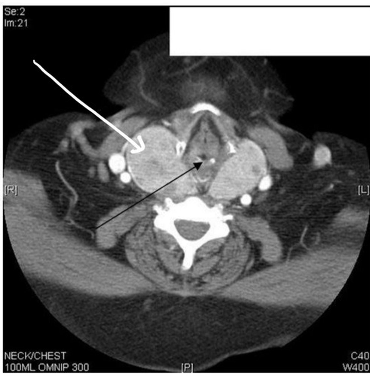 <p>abnormal enlargement of the thyroid gland that's usually due to the lack of iodine<br> *no iodine = no T3 &amp; T4 production = pituitary detect low hormone levels &amp; increases TSH secretion --&gt;&gt;&gt; overgrowth of thyroid follicles = hypertrophy=goiter <br> -symptoms <br> &gt; swelling below the adam's apple<br> &gt; tightness in the throat area<br> &gt; hoarseness (scratchy voice) --&gt; impinges the recurrent laryngeal nerves &amp;/or the laryngeal aperature <br> &gt;swelling of neck vein<br><br>*other causes of goiter --&gt; Graves Disease, Thyroiditis, Thyroid Cancer <br><br><br>*Can compress other neck structures (ex: laryngeal aperature; the trachea)</p>