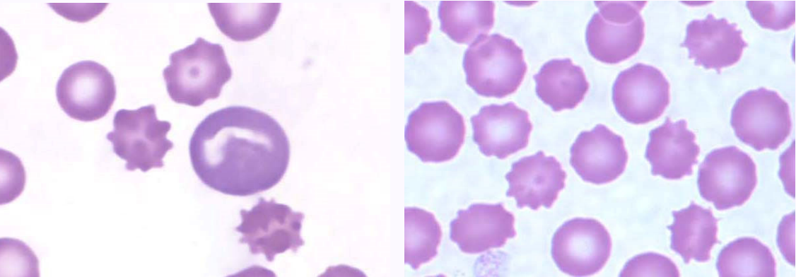 <ul><li><p>RBC morphology characterized by evenly spaced, blunt projections around the entire surface</p></li><li><p>artifact of delayed drying of blood smear on the slide; rarely pathogenic process</p></li></ul><p></p>